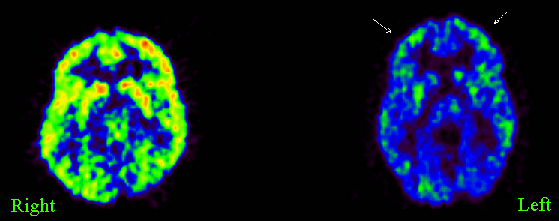 Depression - Depressed brain and normal brain